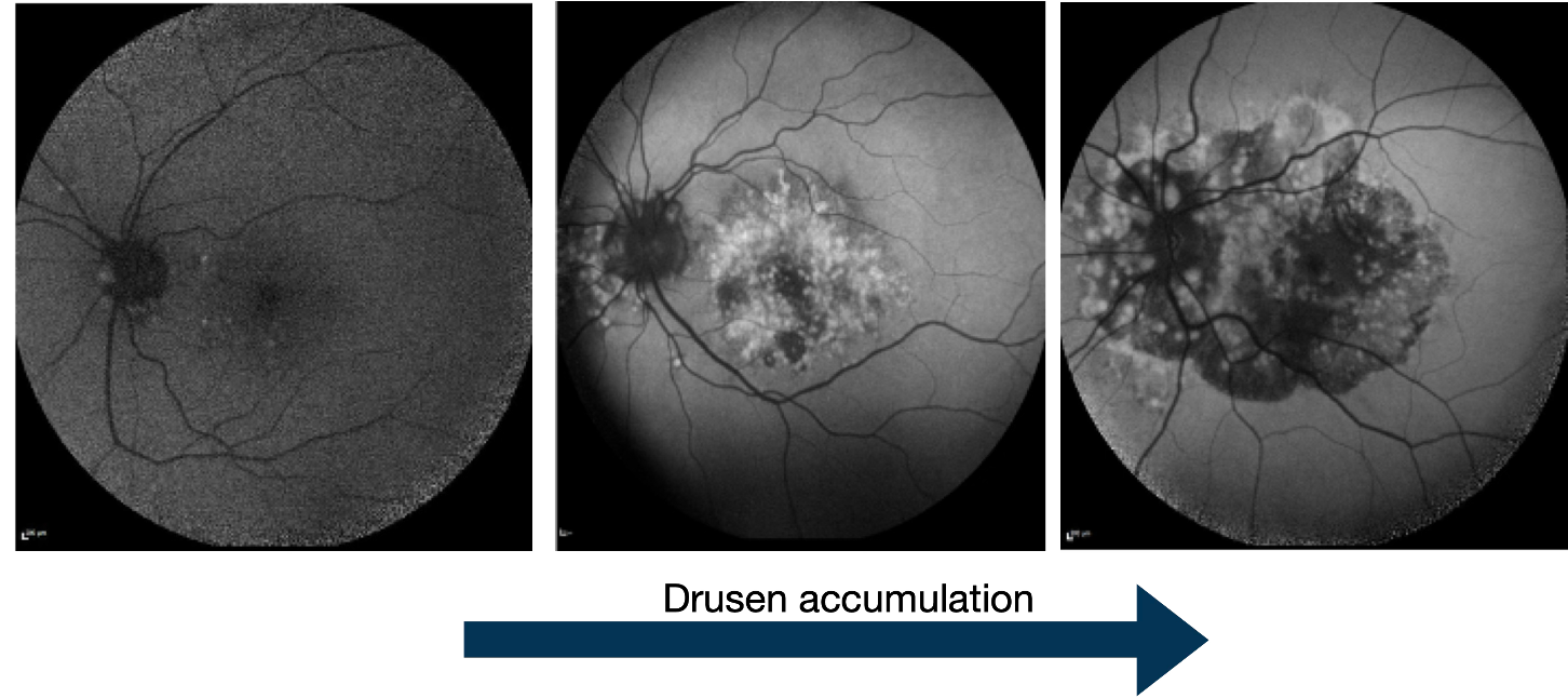 Fundus autofluorescence showing drusen accumulation with disease progression